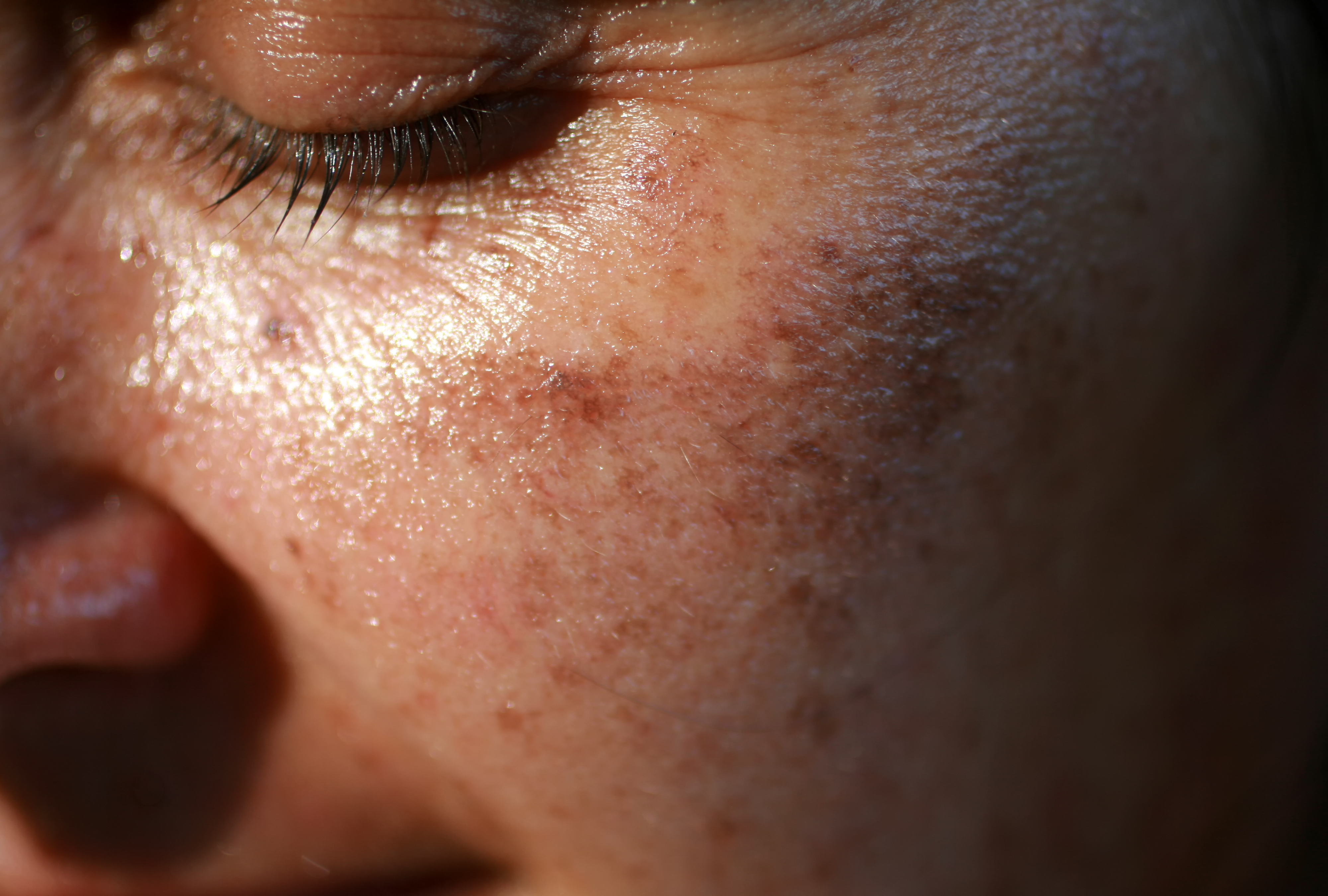 Pigmentation Dark Spots